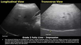 Grade 2 Fatty Liver Ultrasound Report Example | Diffuse Hepatic Steatosis Sonography | Abdominal USG