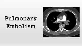 Pulmonary Embolism