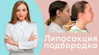 Липосакция подбородка – тотальное преображение лица за 40 минут