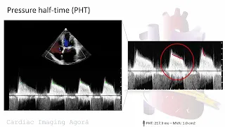 Evaluation of rheumatic mitral stenosis with advanced transthoracic echocardiography