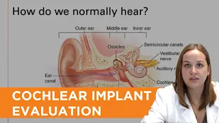 What to Expect at your Cochlear Implant Candidacy Evaluation (captioned)