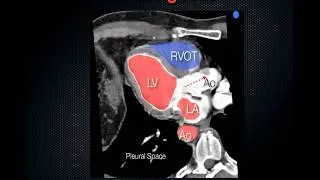 Focused Assessed Transthoracic Echo, FATE exam