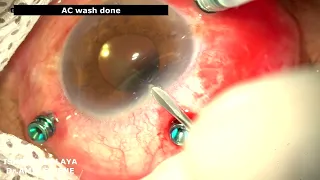 Vitrectomy for post operative endophthalmitis