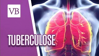 Tuberculose: Transmissão e Fatores de Risco - Você Bonita (24/04/18)