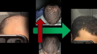 Extreme Hair Loss Recovery Protocol? DON'T DO THIS....