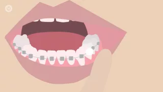 How To Deal With Braces Discomfort - What's Normal, What's Not & What To Do