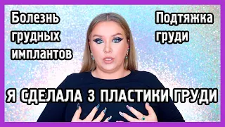 МАММОПЛАСТИКА I Я убрала имлпанты! I Моя история