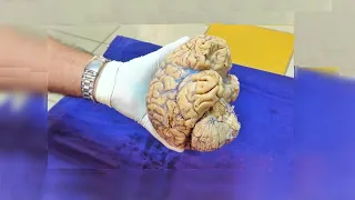 NeuroAnatomy - Basic Parts of the Brain