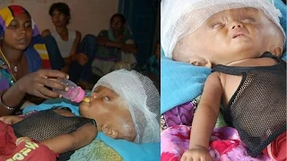 The baby with the 23-inch head: Heartbreaking images show girl whose skull has filled with fluid