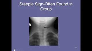 Heuer_Pulmonary Infectious Diseases 11-12-21