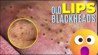 SUPER SATISFYING BLACKHEADS ON LIPS