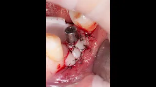 Keratinized tissue improvement around dental implant.