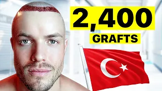 I Got A Hair Transplant In Turkey | Surgeon Reacts