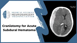 Craniotomy for Acute Subdural Hematoma