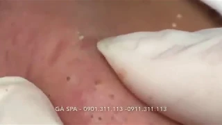 Highlight Professional blackhead popping at its best - GÀ SPA