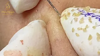 BLACKHEADS REMOVAL (304) | Loan Nguyen