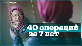 Сирийская девочка перенесла 40 пластических операций