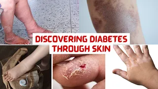 "Diabetes Unveiled: Decoding the 15 Skin Symptoms You Should Never Ignore"