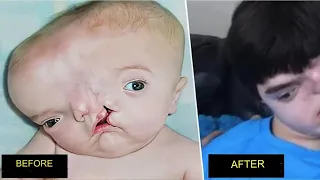 The inspiring story of Johnson, the boy with two faces