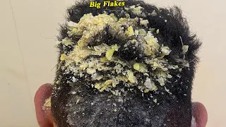 DRY SCALP !! Big Flakes Dandruff Scratching Satisfying Video #807