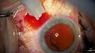 Aqueous Misdirection vs Choroidals during cataract surgery