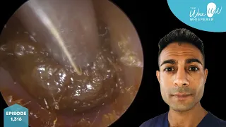1,316 - Squashed-In Ear Wax with Q-tip Removed