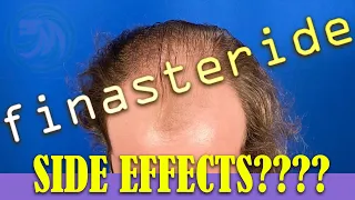 Finasteride for Hair Loss - Steve Talks about using medication Keep your Hair