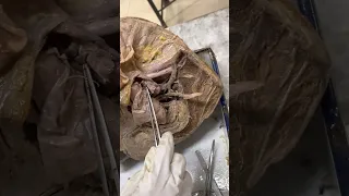Dissection of pelvis and branches of internal iliac artery