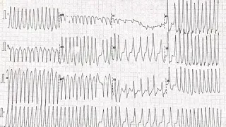 WPW syndrome, Pre-excites AF, CS diverticulum related accessory pathway, RF ablation (epicardial)