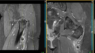 Gluteus muscle tear and anatomy