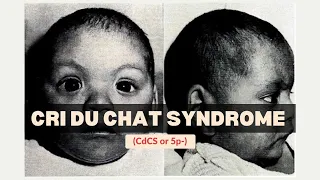 Cri Du Chat Syndrome (CdCS or 5p-) - Genetics | Medicine