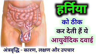 Hernia - हर्निया का आयुर्वेदिक इलाज | Inguinal Hernia Treatment without Surgery