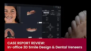 CASE REPORT REVIEW: In-office 3D Smile Design & Dental Veneers