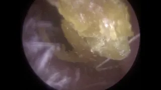 Ear Wax Removal and Dead Skin Removal using Endoscopic Microsuction -  #330