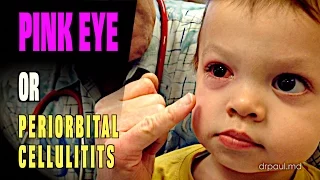 LIVE DIAGNOSIS: Pink Eye or Periorbital Cellulitis? | Dr. Paul