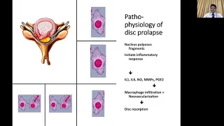 Dr. Ram Chaddha: A Decision Making Algorithmic Approach in Lumbar Degenerative Disorders