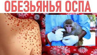 ОБЕЗЬЯНЬЯ ОСПА | Что это за болезнь и стоит ли опасаться эпидемии