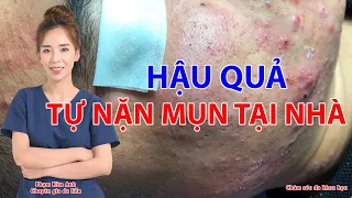 Hậu Quả Khi Nặn Mụn Tại Nhà Không Đúng Cách | Phạm Kim Anh