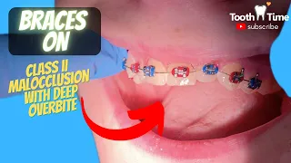 Why I only get braces on my top teeth? Class II Malocclusion with Deep Overbite - Tooth Time