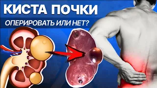 Киста почки, как лечить? Операция нужна не всем и не всегда!