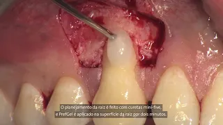 Prof. Dr. Giovanni Zuchelli - Tratamento de Retração Gengival com Emdogain e Mucoderm