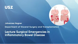 Lecture Surgical Emergencies in Inflammatory Bowel Disease