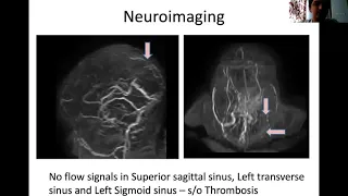 PHO virtual training 12.11.2020: VENOUS THROMBOSIS IN NEONATES