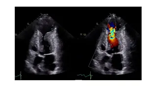 How to Assess the Level of Obstruction with Echocardiography in Patients with HCM
