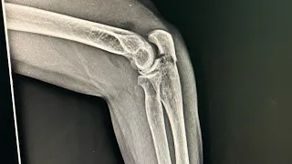 Olecranon Fracture Elbowjoint Xray Radiology #shorts #radiology #fracture