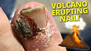 HUGE Granuloma Removal On Infected Ingrown Toenail!