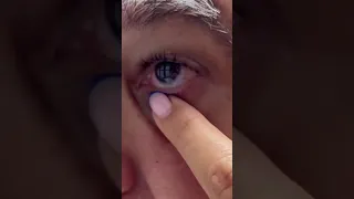 Scleral Lens Insertion and Removal