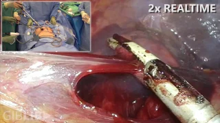 Dr. Lee Performs Larparoscopic Total Colectomy Ileorectal Anastomosis