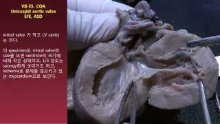 VII. HLHS-55. COA, Unicuspid aortic valve, EFE, ASD