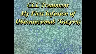 My First Obinutuzumab (Gazyva) Infusion